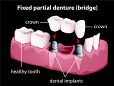 牙齿治疗图案设计图片